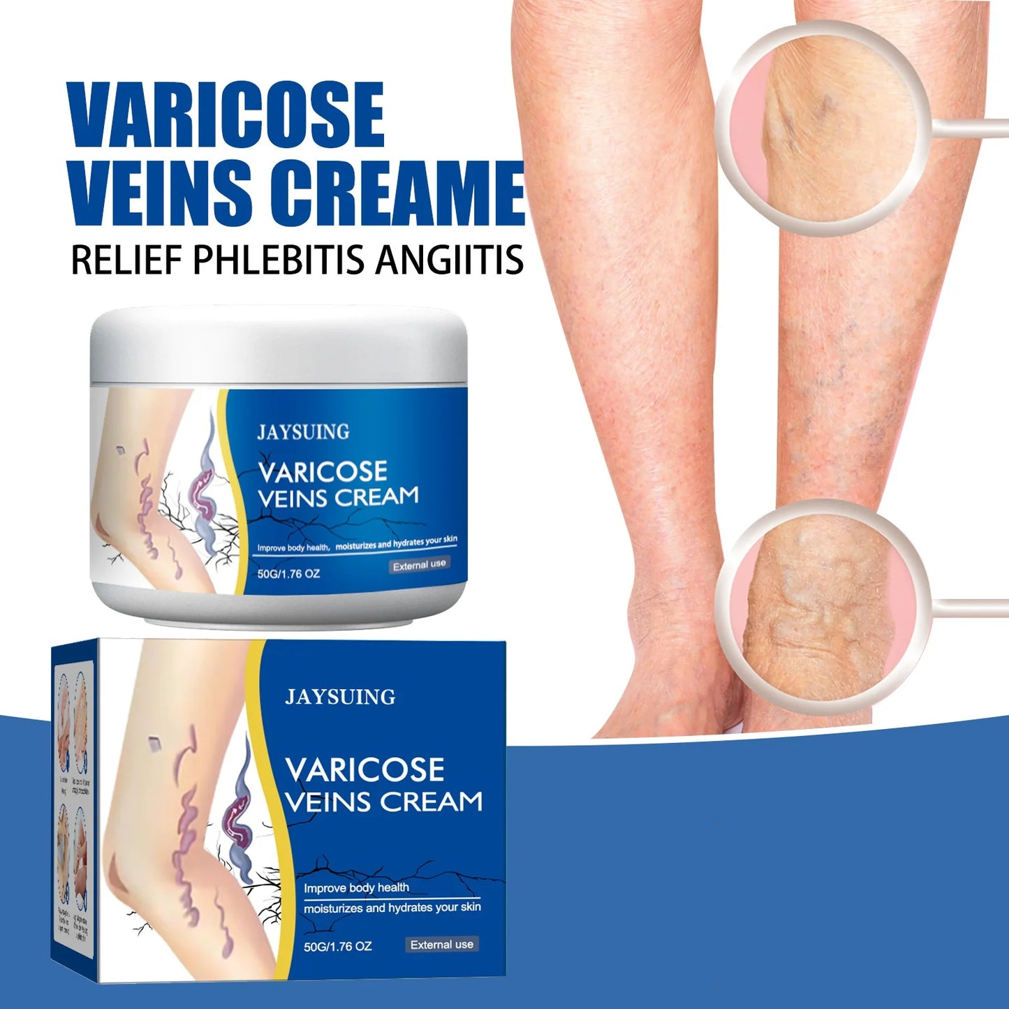 Jaysuing Veins Treatment Cream For Vasculitis Phlebitis Relief
