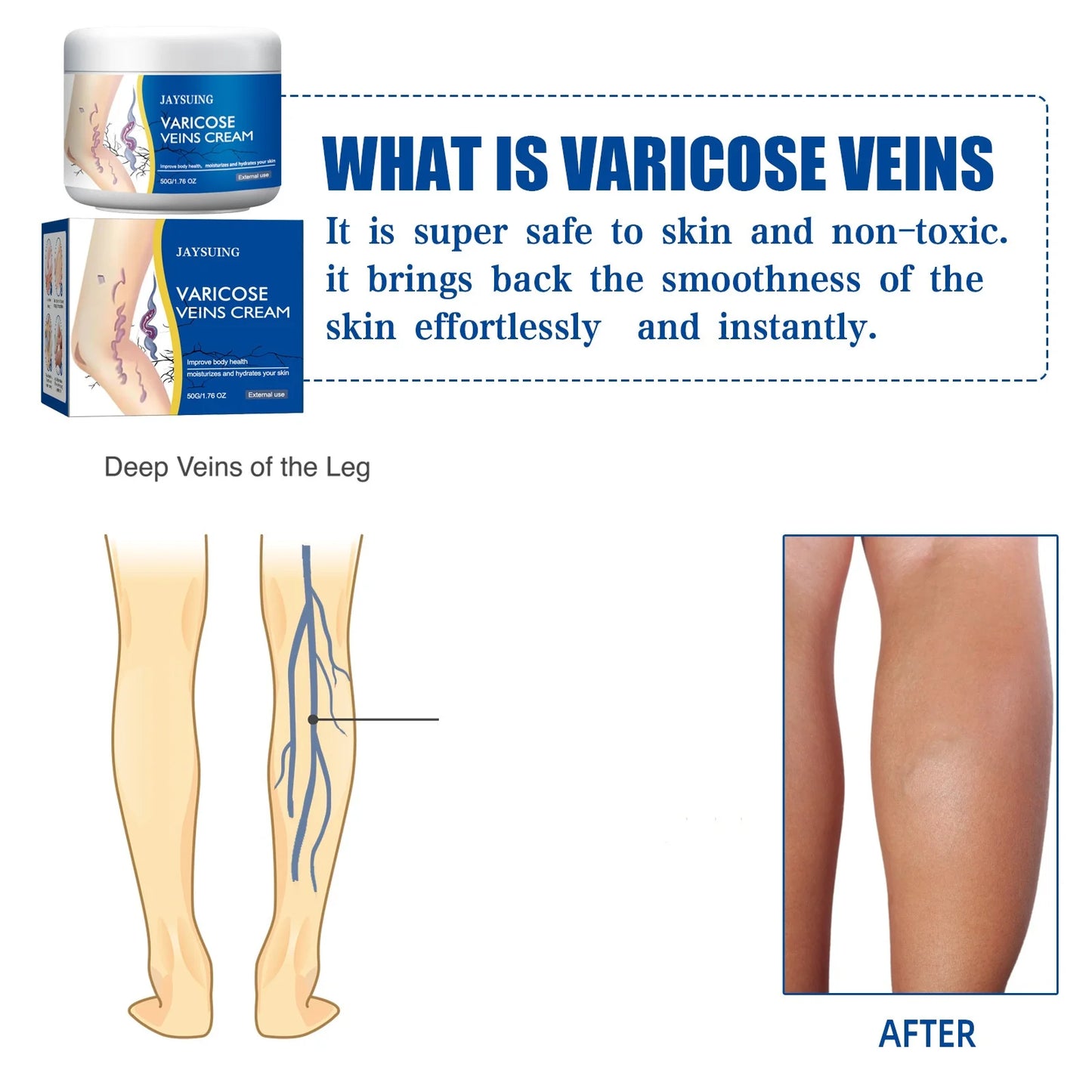 Jaysuing Veins Treatment Cream For Vasculitis Phlebitis Relief